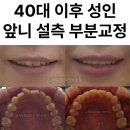 가지런한이연합치과교정과치과의원 | 40대 50대 중년 설측 앞니 부분교정, 윗니만 고친 후기. 송파구 교정치과
