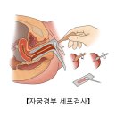 질암[Vaginal Cancer]여성질환, 종양혈액질환 이미지