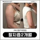 이랑바이오 | 부산지방흡입 팔지흡 2개월차 후기 주차별 변화 후관리 흉터