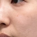 이랑고랑 | #눈밑고랑 #눈물고랑 없애기! 포레스트리프팅 후기