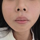 브이마케팅 | 은평구 웨딩관리 : 구파발 멜로즈뷰티 브이라인 관리 후기