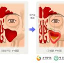 비염인 줄 알았는데 '부비동염'...주요 증상과 치료법은? 이미지