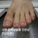 지인의네일 | 삼천포 발톱 무좀 지인의 3-4회차 관리 후기