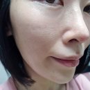 희망의 빛 | 부산해운대센텀피부과 ASCE엑소좀+얼굴홍조관리 V레이저 받고온 후기