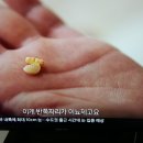 승모 판막 폐쇄 부전증2. 이미지