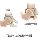 일과성고관절활액막염 (Transient synovitis of hip 이미지