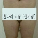 [대구 휜다리] 휜다리교정. 오다리교정. 1회.2회.4회.5회 변화과정 이미지