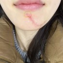 맘스외과성형외과의원 | 함희정성형외과의원 흉터제거 후기 (한달 후기)