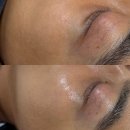 세실로 | 남자친구가 받은 해운대왁싱? 트랜디아이 스킨플래닝으로 대체했어요!
