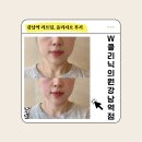 리연의원 | [강남 리프팅] 올리지오 리프팅 받고 탄력 살아난 후기!