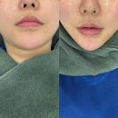 화인 | 약수역피부과 리프팅 후기 온다 국산버전 화인웨이브 리프팅 내돈내산 후기