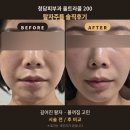 김피부과의원 | 청담피부과 팔자꺼짐 고민, 울트라콜 200 솔직후기