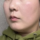 400 | 울쎄라 프라임 400샷 효과 내돈내산 한달 후기