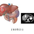 혈관종 이미지