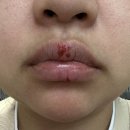 바른약국 | 헤르페스 입술포진 약국 연고 후기 – 생리 주기에 재발한 이유와 대처법