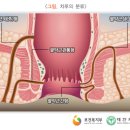 치루개 네이버블로그