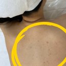 평촌92 | 안양 평촌 과천 여드름 등드름 등여드름 관리 후기 더마클리어센터 에스테틱