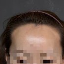 채움 | smp 헤어라인교정 두피채움후기 위브로