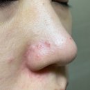 감동한의원 | 깊고 큰 모공흉터 전문한의원 모공치료 5회차 후기(감동 주의)