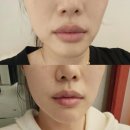 강남역피부과 울쎄라피프라임 300샷 60대 엄마와 딸 울쎄라 후기/ 통증 적음
