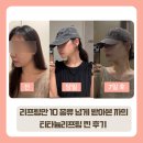 다운체 | [명동피부과] 티타늄리프팅 솔직 후기｜통증·효과·다운타임·일주일 전후 변화