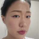 제일시장한의원 | (여드름흉터치료) 파인흉터 새살약침 2회차 누적 새살침4회 율각테라피3회 천안 여드름전문한의원 찐후기