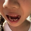 라스어린이치과의원 | 큰앙꼬 발치를 부탁해 [라스어린이치과의원]