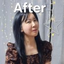 리얼라이너 | 턱보톡스보다 좋았던 얼굴 윤곽주사 마블주사 3차 리얼 후기 튠라이너 붓기