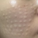 나노의원 | 리포좀/나노리포좀/엑소좀 차이는 무엇인가