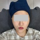 타임성형외과의원 | 24기 나는솔로 순자 올타이트리프팅 신사역성형외과에서 하고 효과 전후사진비교