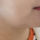 웨어웨어-뷰티 | 루원시티 피부샵 웨어웨어뷰티 이중턱 리프팅 받은 솔직 후기