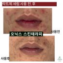퀄리티 | 좁쌀, 화농성 트러블 계속 올라오는 이유? 여드름세럼 사용 후기 (바이더퀄리티 락트제 세럼)