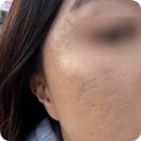 명동한의원 여드름흉터 새살침 내돈내산 2주일차 비포애프터 후기