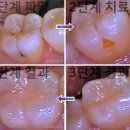 상아치과재료 이미지