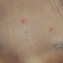 (주)바를참스킨 | 청소년 여드름 화장품 사춘기 중학생 기초 관리 스킨로션 후기