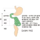 소장암 이미지