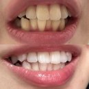 대인치과의원 | 신사역 레브치과 내돈내산 서울 치아미백 3회 한달 후기 유지기간 가격 전후 효과