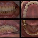 필치과병원 | 배방근처치과, 보철 치료 후 정기 검진이 중요한 이유!?[정출, 전치부 부분교정]