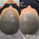 더몽드스킨 | 망한 두피문신, 포기하지 마세요 "몽드랩 복구 케이스 모음"