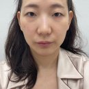 디오디피부과의원 | 청담 티타늄리프팅 후기 디오디피부과청담본점