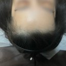 모비디크 | 신촌 탈모커버 잘하는 곳 “모비디크뷰티” 헤어라인 두피채움 M자탈모관리 솔직후기