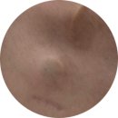 정원의원 | [#11 삼중음성 유방암] 서울 아산병원 케모포트 제거 시술 후기 아침정원 의원 세상 친절쓰