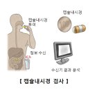 소장암(Small bowel cancer) 이미지