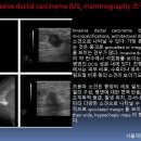 Invasive ductal carcinoma 이미지