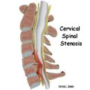 요추협착증 (Lumbar spinal stenosis) 이미지