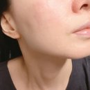 가름커피 | 신논현피부과 통증 없는 포트라리프팅(티타늄 업그레이드) 내돈내산 후기