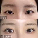 하니성형외과 자연유착 매몰 쌍수 한달차 후기 + 최근근황