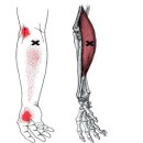 테니스엘보우 1: 증상과 통증&amp; 검사방법 이미지