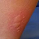 알레르기 이미지