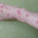 백년초한방병원 | 다리 홍반에 도움 되는 아토샵 솔루션